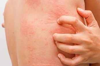 Ngứa dai dẳng, mệt mỏi không rõ nguyên nhân? Có thể bạn đang nhiễm sán chó mà không hề hay biết!